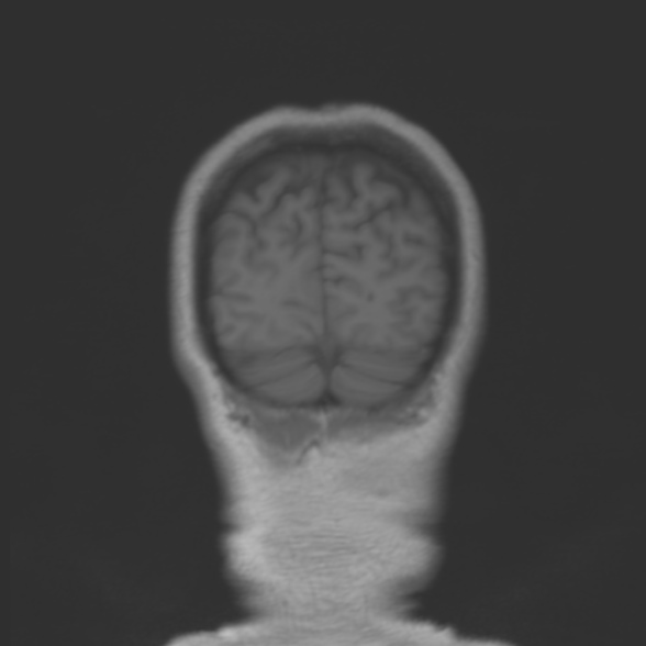 File:Cerebellopontine angle meningioma (Radiopaedia 53561-59591 Coronal T1 21).jpg