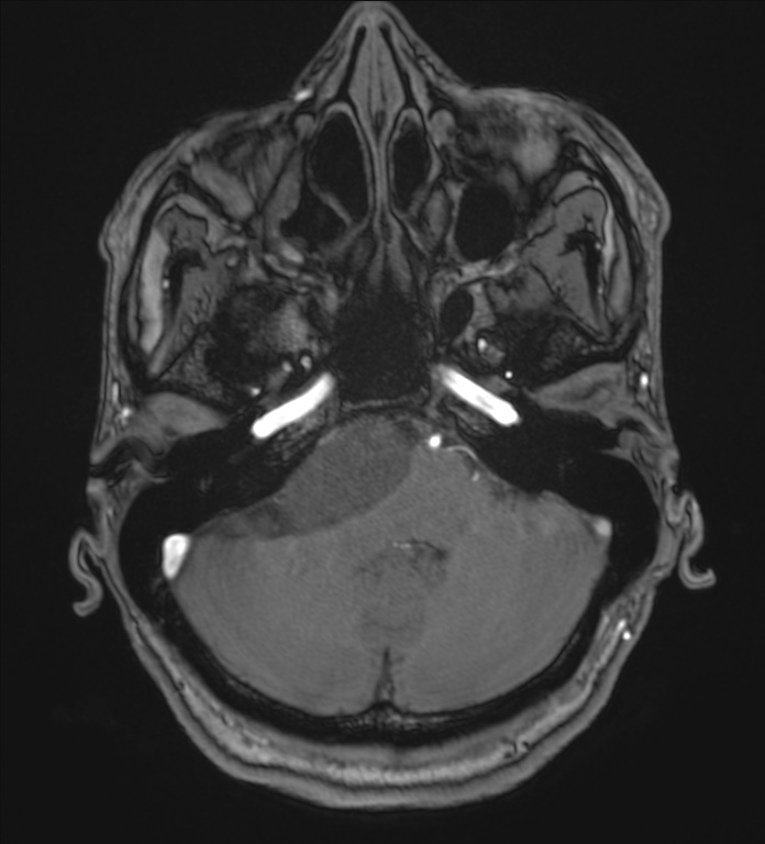 Cerebellopontine angle meningioma (Radiopaedia 72983-83680 Axial MRA 22).jpg