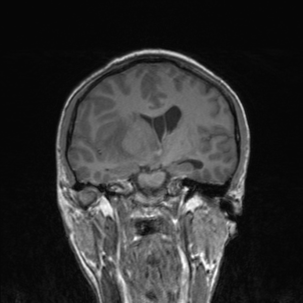 Cerebral abscess (Radiopaedia 24212-24478 Coronal T1 108).jpg