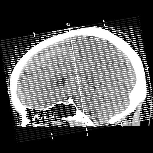 Cerebral abscess (Radiopaedia 29451-29919 Axial non-contrast 1).jpg