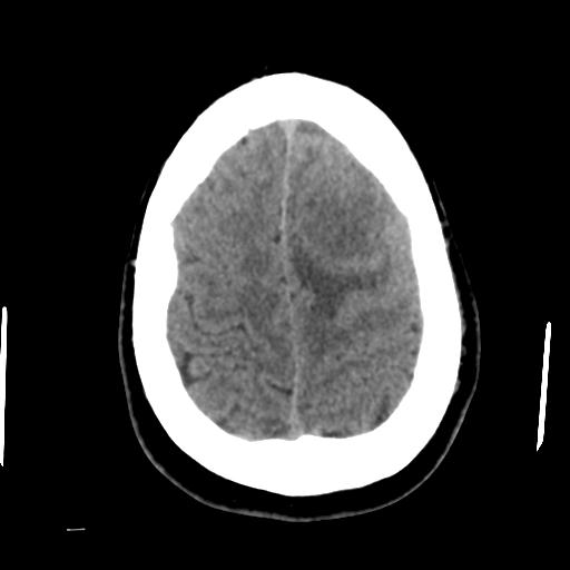 Cerebral abscess (Radiopaedia 29451-29919 Axial non-contrast 42).jpg