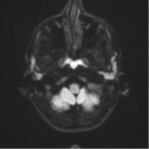 Cerebral abscess (Radiopaedia 60342-68009 Axial DWI 39).png