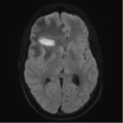 Cerebral abscess (Radiopaedia 60342-68009 Axial DWI 54).png
