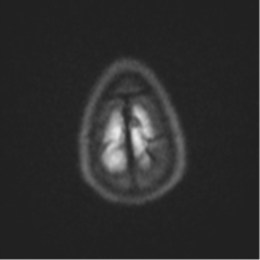 Cerebral abscess (Radiopaedia 60342-68009 Axial DWI 70).png
