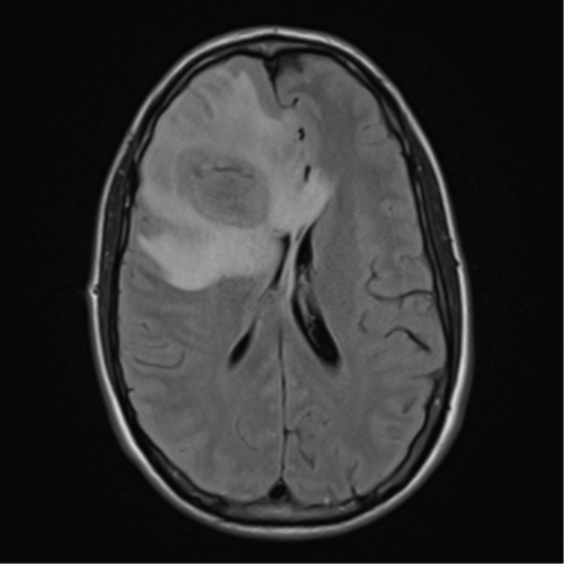 File:Cerebral abscess (Radiopaedia 60342-68009 Axial FLAIR 18).png