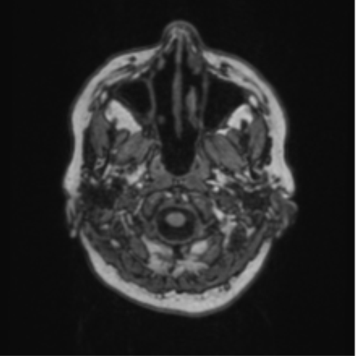 Cerebral abscess from pulmonary arteriovenous malformation (Radiopaedia 86275-102291 Axial T1 6).png