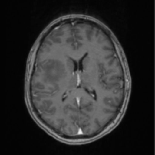 Cerebral abscess from pulmonary arteriovenous malformation (Radiopaedia 86275-102291 Axial T1 C+ 44).png