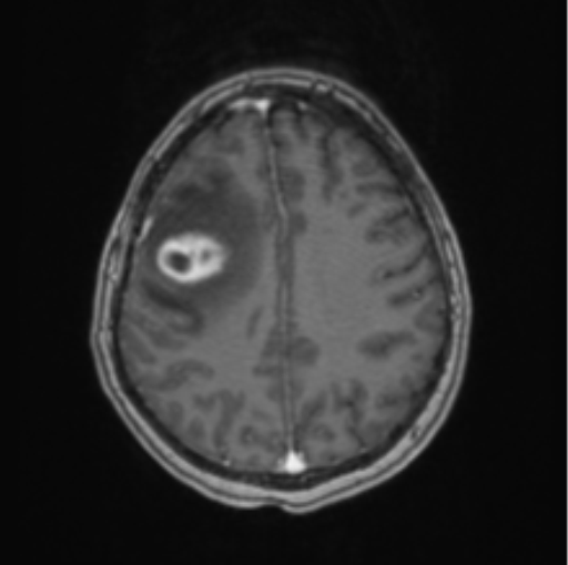 Cerebral abscess from pulmonary arteriovenous malformation (Radiopaedia 86275-102291 Axial T1 C+ 53).png