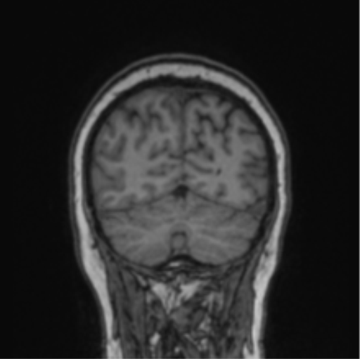 Cerebral abscess from pulmonary arteriovenous malformation (Radiopaedia 86275-102291 Coronal T1 22).png