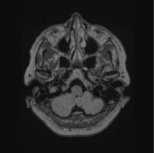 Cerebral abscess from pulmonary arteriovenous malformation (Radiopaedia 86275-102291 J 15).png