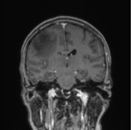 Cerebral abscess from pulmonary arteriovenous malformation (Radiopaedia 86275-102291 L 43).png