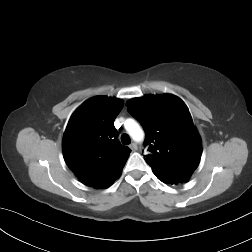 File:Cerebral abscess from pulmonary arteriovenous malformation (Radiopaedia 86275-102292 A 19).png