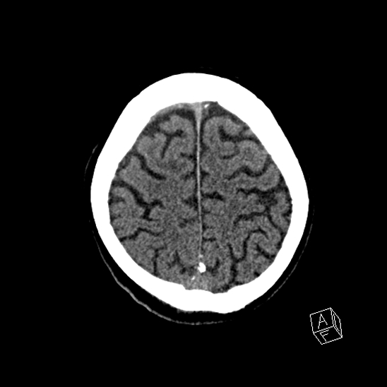 Cerebral abscess with ventriculitis (Radiopaedia 78965-91876 Axial non-contrast 41).jpg