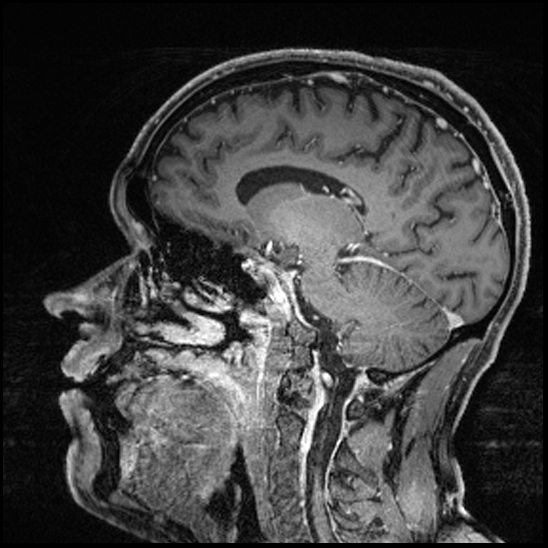Cerebral abscess with ventriculitis (Radiopaedia 78965-91878 Sagittal T1 C+ 105).jpg