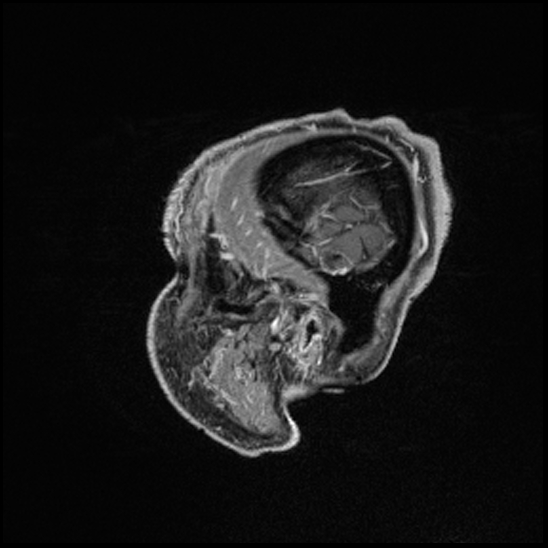 Cerebral abscess with ventriculitis (Radiopaedia 78965-91878 Sagittal T1 C+ 19).jpg