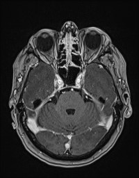 Cerebral amyloid angiopathy-related inflammation (Radiopaedia 58270-65377 Axial T1 C+ fat sat 38).jpg