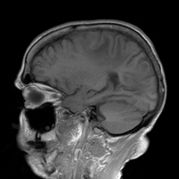 File:Cerebral amyloid angiopathy-related inflammation (Radiopaedia 74836-85849 Sagittal T1 13).jpg