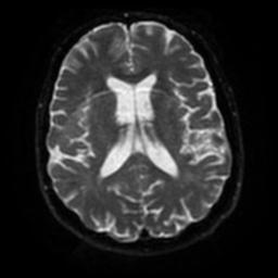 Cerebral amyloid angiopathy (Radiopaedia 28698-28978 Axial DWI 45).jpg