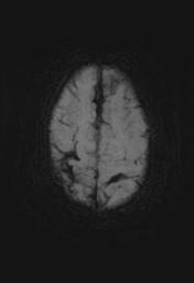 File:Cerebral amyloid angiopathy (Radiopaedia 29129-29518 Axial SWI MIP 26).jpg
