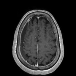 Cerebral amyloid angiopathy (Radiopaedia 29129-29518 Axial T1 C+ 118).jpg