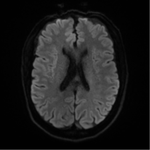 File:Cerebral amyloid angiopathy (Radiopaedia 46082-50433 Axial DWI 43).png