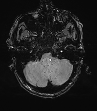 File:Cerebral amyloid angiopathy (Radiopaedia 46082-50433 Axial SWI 14).png