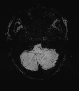 File:Cerebral amyloid angiopathy (Radiopaedia 46082-50433 Axial SWI MIP 12).png