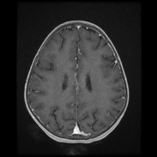 Cerebral and spinal tuberculosis (Radiopaedia 90489-107837 Axial T1 C+ 132).jpg