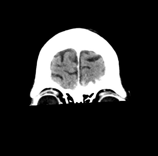 File:Cerebral aneurysm with rupture (Radiopaedia 29933-30460 Coronal non-contrast 5).jpg