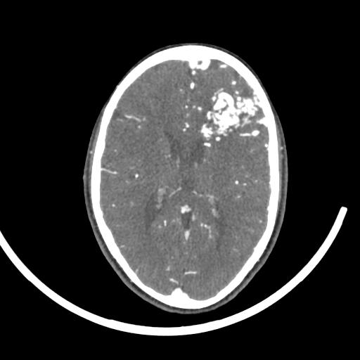 File:Cerebral arteriovenous malformation (Radiopaedia 29531-30031 E 34).jpg