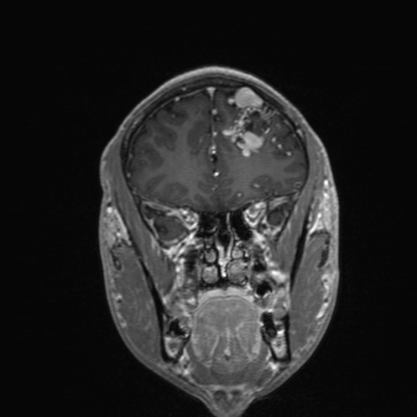 Cerebral arteriovenous malformation (Radiopaedia 30198-30813 F 19).jpg