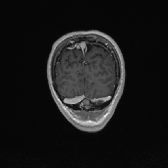Cerebral arteriovenous malformation (Radiopaedia 30198-30813 F 52).jpg