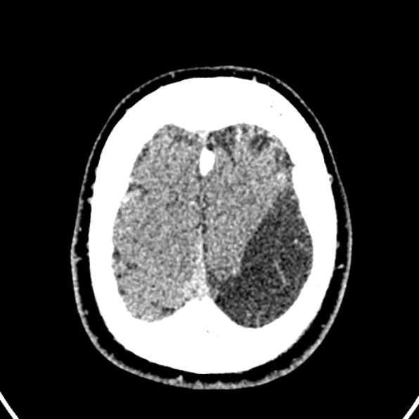 Cerebral arteriovenous malformation (Radiopaedia 37182-39012 Axial non-contrast 42).jpg