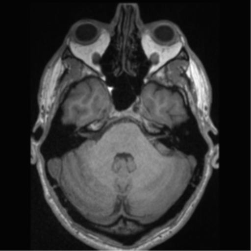 Cerebral arteriovenous malformation (Radiopaedia 55798-62372 Axial T1 14).png