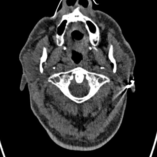 Cerebral arteriovenous malformation (Radiopaedia 78188-90746 Axial non-contrast 1).jpg