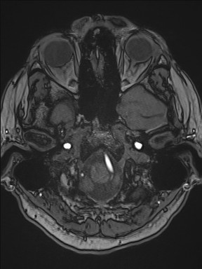 Cerebral arteriovenous malformation (Radiopaedia 84015-99245 Axial TOF 61).jpg