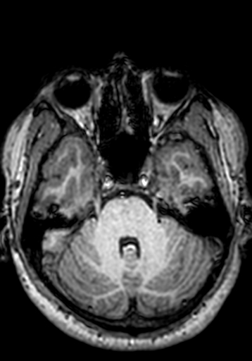 Cerebral arteriovenous malformation at posterior body of corpus callosum (Radiopaedia 74111-84925 Axial T1 227).jpg