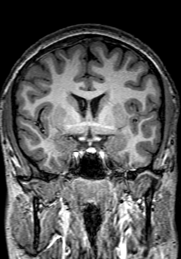 Cerebral arteriovenous malformation at posterior body of corpus callosum (Radiopaedia 74111-84925 Coronal T1 136).jpg