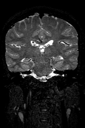 Cerebral arteriovenous malformation at posterior body of corpus callosum (Radiopaedia 74111-84925 Coronal T2 101).jpg