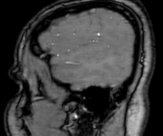 Cerebral arteriovenous malformation at posterior body of corpus callosum (Radiopaedia 74111-84925 J 26).jpg
