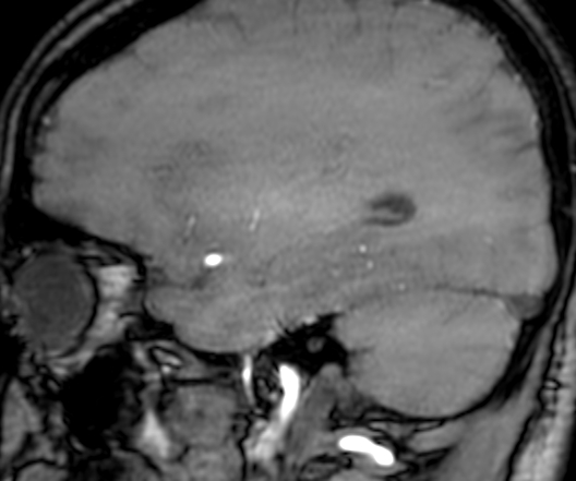 Cerebral arteriovenous malformation at posterior body of corpus callosum (Radiopaedia 74111-84925 J 287).jpg