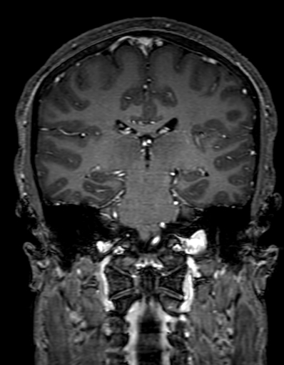Cerebral arteriovenous malformation at posterior body of corpus callosum (Radiopaedia 74111-84925 K 213).jpg
