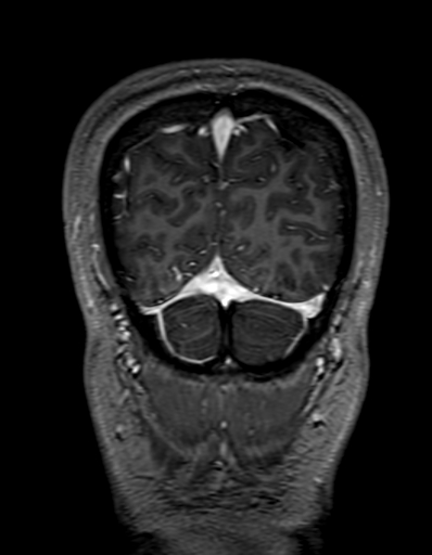Cerebral arteriovenous malformation at posterior body of corpus callosum (Radiopaedia 74111-84925 K 336).jpg