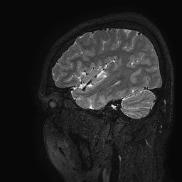Cerebral arteriovenous malformation at posterior body of corpus callosum (Radiopaedia 74111-84925 Sagittal T2 22).jpg