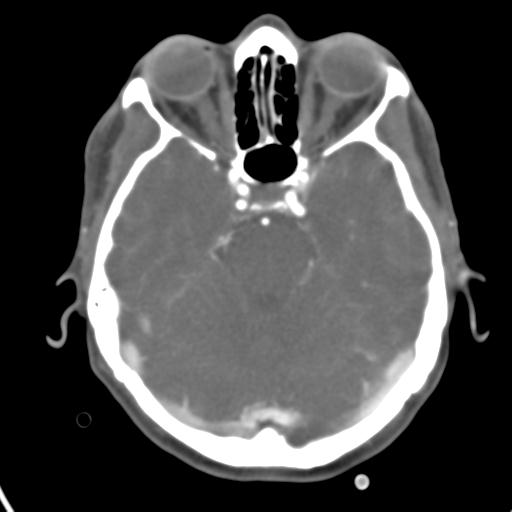 Cerebral arteriovenous malformation with hemorrhage (Radiopaedia 28773-29073 A 37).jpg