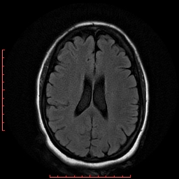 File:Cerebral cavernous malformation (Radiopaedia 26177-26306 FLAIR 14).jpg