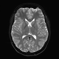 Cerebral cavernous venous malformation (Radiopaedia 70008-80021 Axial DWI 17).jpg