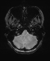 Cerebral cavernous venous malformation (Radiopaedia 70008-80021 I 10).jpg