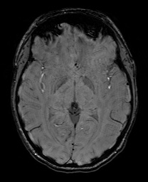 Cerebral cavernous venous malformation (Radiopaedia 70008-80021 I 35).jpg