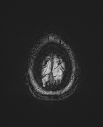 Cerebral cavernous venous malformation (Radiopaedia 70008-80021 I 72).jpg